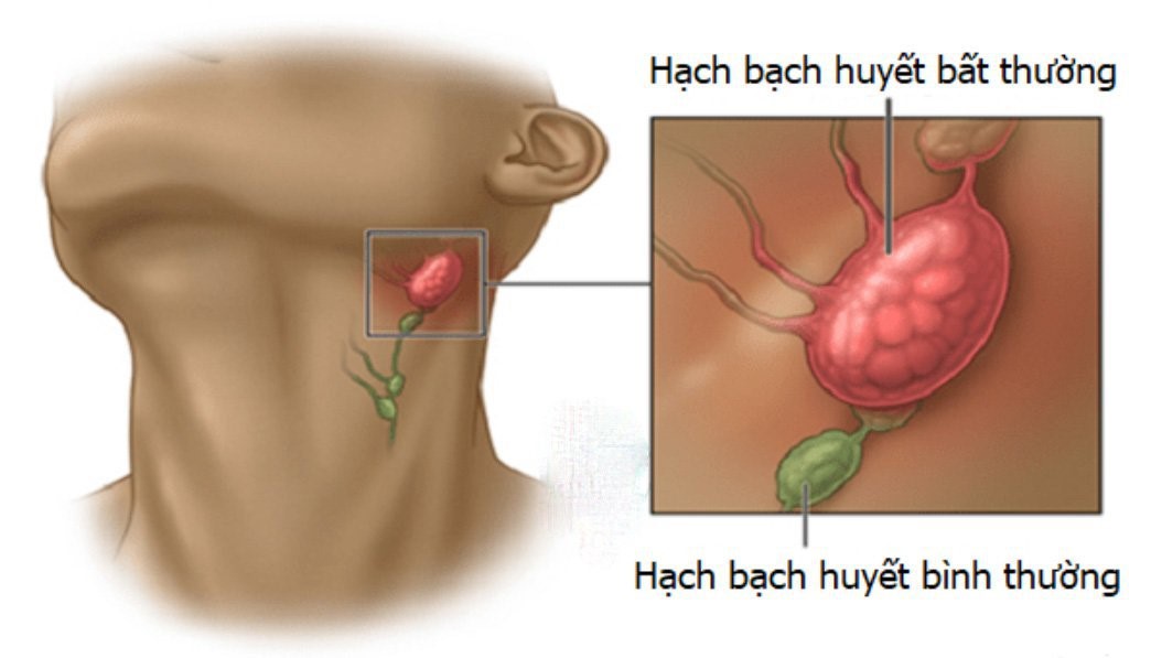 Nạo vét hạch cổ chức năng